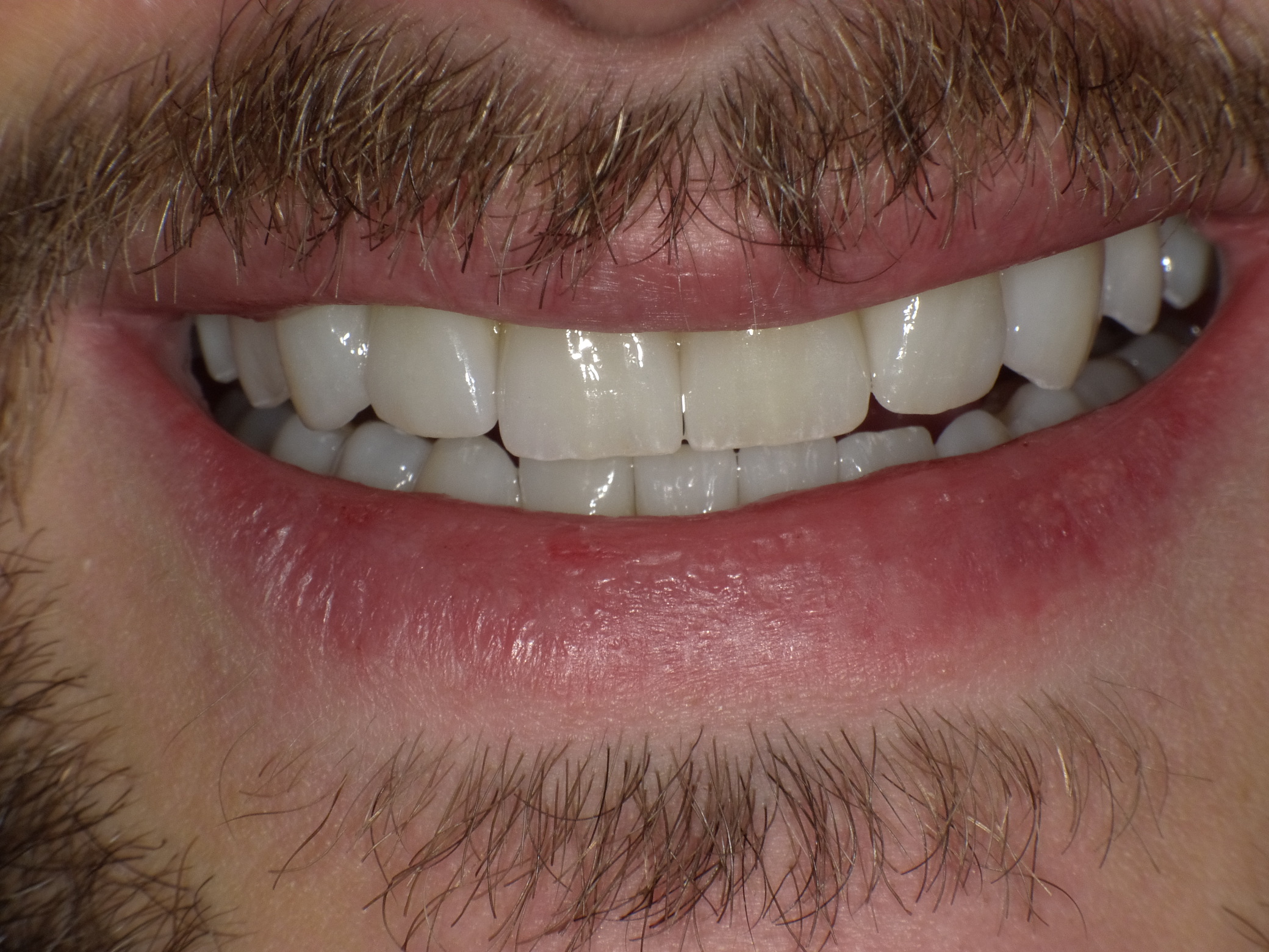 Komplettbehandlung mit Bisshebung, Setzen von Implantaten als Ersatz für die Milchzähne, Schaffen einer völlig neuen, ästhetischen Gesamtsituation mit vollkeramischen Kronen und Brücken